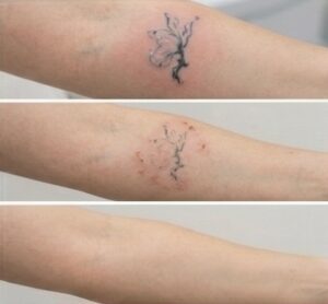 Laser Tattoo Removal Harrogate - Before & After